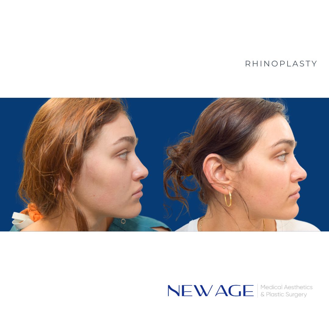 Rhinoplasty Nose Job New Age Aesthetics in Ottawa